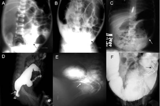 Radiografía con casos de Hirschsprung. Wikimedia Commons